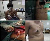 Thoraco-Abdominal Impalement Injury With Two Construction IronbarsA Rare Case Report from abdominal
