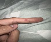 I know the internet is a bad place to get medical advice, but I was wondering if someone could help me identify this tiny lesion on my index finger. If I apply pressure to it there is a little discomfort. Any ideas on how to get rid of it? Thank you. from kvetina index