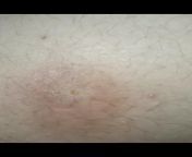 Ingrown hair has pus and blood leaking from it, what is happening to me ? I&#39;m scared from defloration 1st sex blood leaking