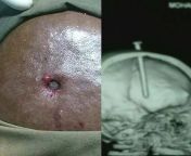 The case of a patient that inserted a nail in his head after suffering a severe case of migraine in the hope to relieve the extreme pain !! from extreme pain