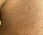 Few months old but just started itching area inside thigh. Folliculitis, regular rash, or chafing? from redlight area inside room videos