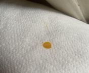 Pooped out this waxy orange substance. It wasnt a lot but I got a drop on the toilet seat and it dried into a solid like wax. WHY AM I POOPING ORANGE WAX!!!? from girls on the toilet pooping