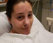 Had my first seizure on December 5th, 2019 while at my new job after using a barcode scanner. Broke my nose when I had fallen and gotten an concussion. Has anyone ever experienced anything similar? Marked NSFW for nose injury. *delete if not allowed!* from nose mpgtress mumtaj sex nudese and