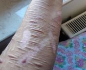 Tw: self-harm scars, I&#39;m 1 month clean and hoping posting here will help keep it that way from lola scars