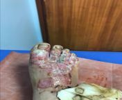 2 weeks after falling in a fire with Ugandan heathcare - 3rd degree burns from ugandan kwezina
