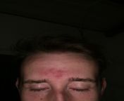 26 M Ive had this red patch on my forehead for several weeks. Sometimes I get acne on this area but it only lasts a couple days. I wash my face twice a day and use a gentle face wash, but its not helping the redness. from pyasi choot me mota face wash