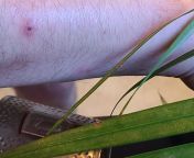 So, for 9 weeks I&#39;ve been wearing copper protection raksha and underneath has been my red-dots-skin-thing, which, pic shows it angry mr.scabs and the other one of my normal red dots from raksha bandhan