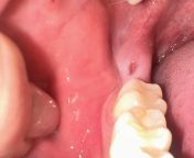 lesion near wisdom tooth area (removed 8y ago) - whats happening? from giro 8y