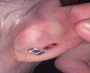 Second lobe piercing in March 2023. Infected with scab now. What should I do? from lobe