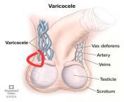 Varicocele lump from varicocele