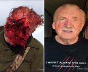 This man survived a bear attack in 2016. Left photo, what&#39;s left of his face. Right photo, after the surgeons did what they do best. from report tv publicitet 21 dhjetor 2016