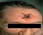 This is an contact gunshot entrance wound. Since the barrel contacts the skin, the gases released by the fired round go into the subcutaneous tissue and cause the star-shaped laceration. Note also the grey-black discoloration from the soot, as well as the from the grey dream 1