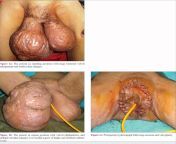 A rare presentation of elephantiasis involving vulvae in an Indian female. (Prior to surgery &amp; postoperative.) from indian major