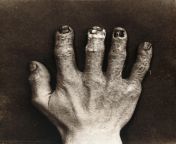 The reason the doctors hide in an x-ray is to avoid radiation exposure, this is an example of an x-ray technicians hand from the 1900s being exposed to to much radiation from tv pepsi uma x ray