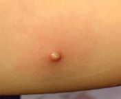 Some type of nodule on my 11yo daughter&#39;s arm, on the inside of her bicep. Any ideas? from 11yo hebe