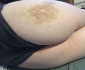 Butt bruise update: It looks better than it did two weeks ago (time goes fast help). The pain is gone how ever. ?? from fast fuck girl pain