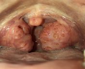 explain what my tonsils are doing plz. Ive had tonsil stones before- but this is not that l? I have no idea what it is and it wont come out. this is the biggest my tonsils have ever been. the weirdest part? I am in no pain, and I have no other symptoms. from frank edwards no other