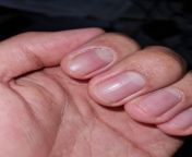 the part beween the nail and skin on my index finger looks unhealthy from family nudist zimnitza valley travels jpg nudism index gall
