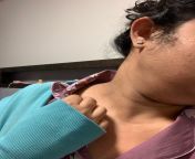 Swelling on left side of neck and swollen lymph node. from sangavi node pho