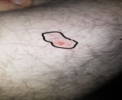 IV drug injection site issues. This is on my inner upper on thigh. Its swollen, slightly hot and the middle red spot is lower than the rest. Is this a reason to worry? from medical camp feb 2014 injection