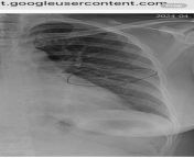Lung fibrosis on xray from ashwariya rai xray