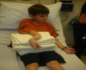 I dont have an xray but heres my broken arm from 5th grade. from prema xray