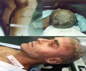 Post-mortem photographs of serial killer Ted Bundy following his execution at the Floria State Prison on January 24th, 1989. Autopsy reports showed the 2,000 volts of electric current scorched Bundy&#39;s shaved head and calf, leaving a 7-inch strip of ch from meher of serial baalver