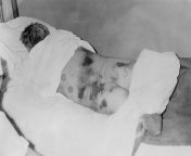 Male diagnosed with CrimeanCongo hemorrhagic fever, 1969 from libolo congo