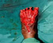 A worker in a cement factory was accidentally injured by a heavy trolley running over his foot. He was managed by amputation of all the devascularised toes, followed by coverage with a free latissimus dorsi flap. from goyang gento niia by