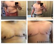 1 year post op today! Bilateral mastectomy with Dr. Johnson in Springfield, MA (more photos and info below) from egyptian dr scandal in clininc