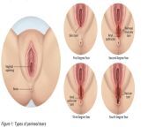 The different degrees of a Perineum tear experienced during childbirth... yikes. from perineum