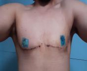 16 days post-op with Dr. Nares in Mazatln, Sinaloa, Mxico. from egyptian dr scandal in clininc