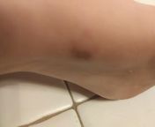 Weird red spot on the arch of my foot appeared overnight. Very painfull. from indian very painfull sex