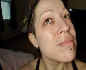 Three months of derm care and just a few weeks of being able to resist picking at my face. Face just washed so completely naked face, not even moisturizer. from completely naked playboy magazine 10 35 sexpornweek com