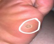 Is this a plantar wart or just a callus? from callus
