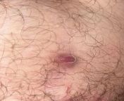 What is this soft lump in one of my stretch marks on my inner thigh? from hand lump