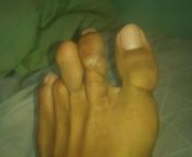 I was born with my left foot like this, my mother was told that the mutilation was due to something related to the umbilical cord, is that true? whats the medical term used in that case. from medical boner