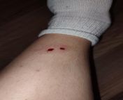 Misjudged how hard I needed to hit something and hit my shin with the claw side of a hammer. from 2173860 micchi hatogaya misae nohara shin chan