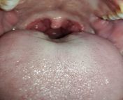 extreme pain swallowing, does this looks like a normal viral infection? from extreme pain