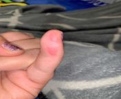 Very very painful red marks on side of my pinky… both of my pinky fingers actually! They hurt and I’m not sure what they are from??? from mypornvidtun pinky vlogs سكس