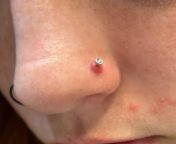 GIANT piercing bump on nostril from nostril