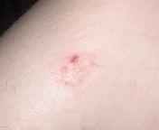 Is this MRSA? from kirah
