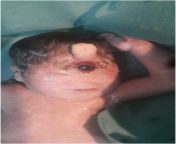 Cyclopia in a newborn girl, born at 7 months gestation. She died after six hours. from girl fakingsex video xdesi mobinglore kannada xxx sexx grals six move