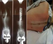 I had scoliosis surgery when I was 12 in 2010. Im coming up on my 10 year anniversary at the end of July. The picture on the right was right after they removed the gauze and tape from my incision. It was pretty nasty, so I thought it would fit best here. from getting hammered on a table nice squirt at the end