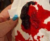 Heavy blood clots while on Slynd from pakistani painful heavy blood sex