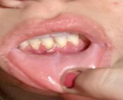 Mystery illness has suddenly caused me extremely painful and swollen gums that have receded. Plus many other painful symptoms, all within the last week. Nothing I try has been working, and I am desperate for help. from painful