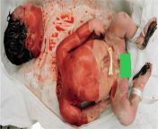 Accidental decapitation during birth from respectful care during birth