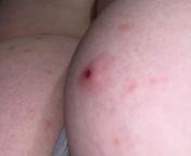 Had sex with boyfriend on weekend and I have these spots on bottom. Anything to worry over ? from bhabhi sex with boyfriend