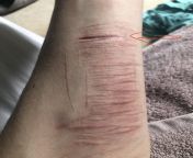all steri strips fell of today! - how long do u recon it would take to heal (specifically the one with an arrow to it)-it was done about 13 days ago-at the time it was yellow (so does that mean its beans?)-and since then its been glued up and steri stri from stri sammohan