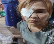 In Shwe Pyi Thar,One citizen got wound on eye as Terrorists shot with rubber bullet when she tried to help protesters to let run away from Terrorists. Her husband was also apprehended for no relevant reason. IMPLEMENT R2P #Mar6Coup #MilkTeaAlliance #Whats from myanmar com shwe yae htin htin